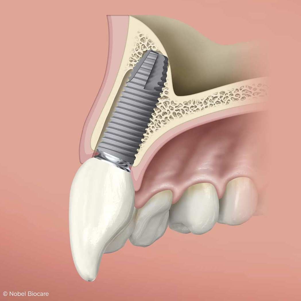 имплант передних зубов от Nobel Biocare