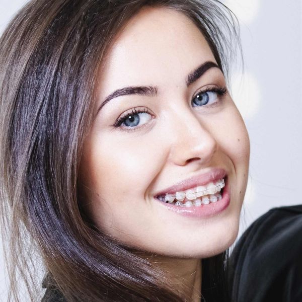 керамические безлигатурные брекеты Damon clear или подобные