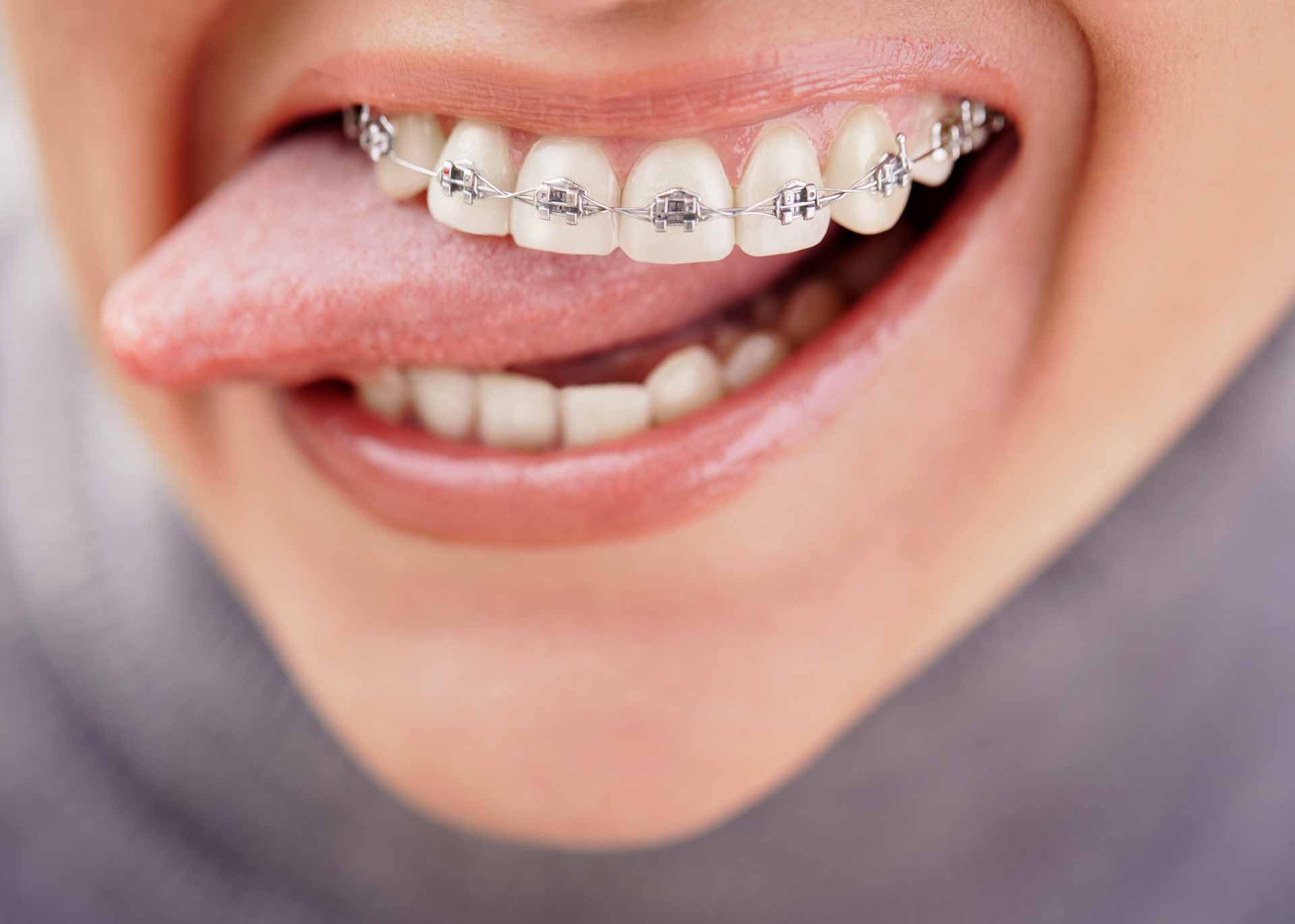 металлические лигатурные брекеты