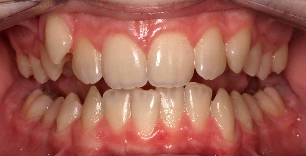 ортодонтическое лечение в БИЭМ Москва, фото прикуса пациентов до и после лечения