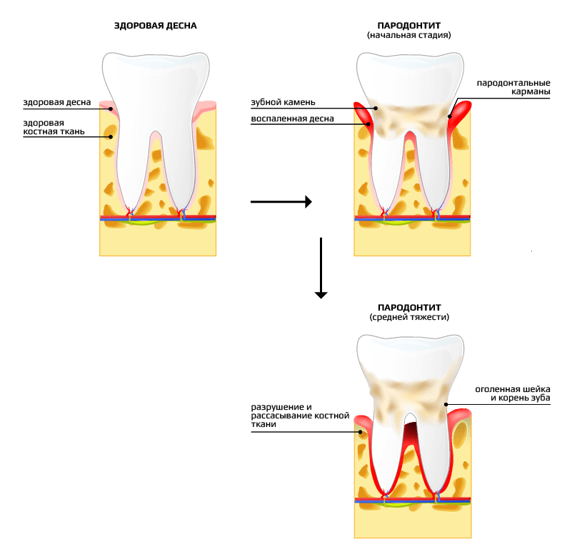 Схема лечения пародонтита