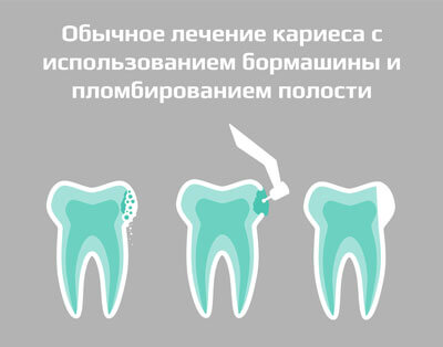 Схема лечения кариеса бормашиной
