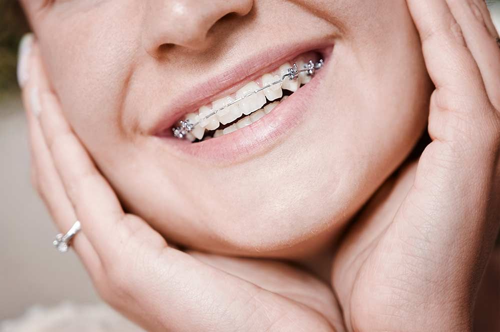 Эстетические малозаметный брекеты