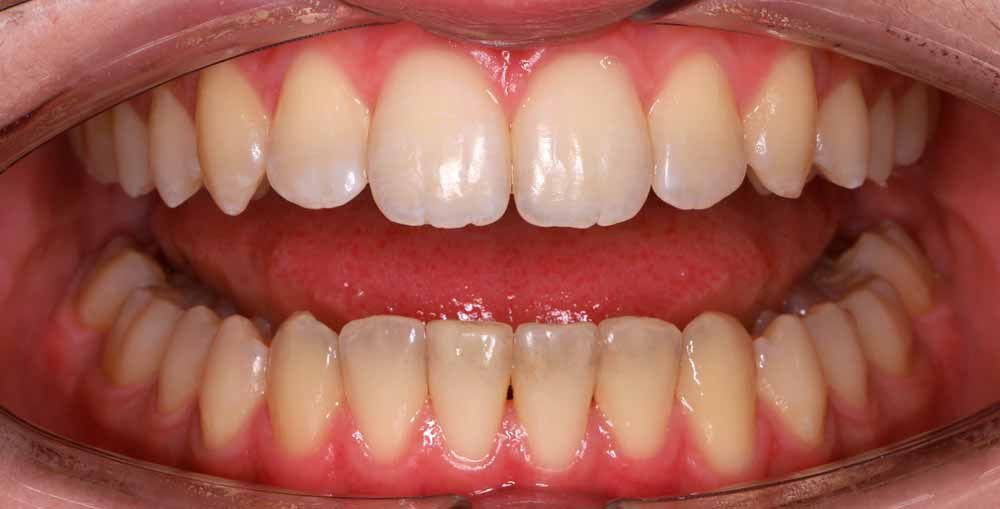 ортодонтическое лечение в БИЭМ Москва, фото прикуса пациентов до и после лечения