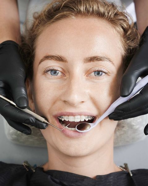 металлические брекеты