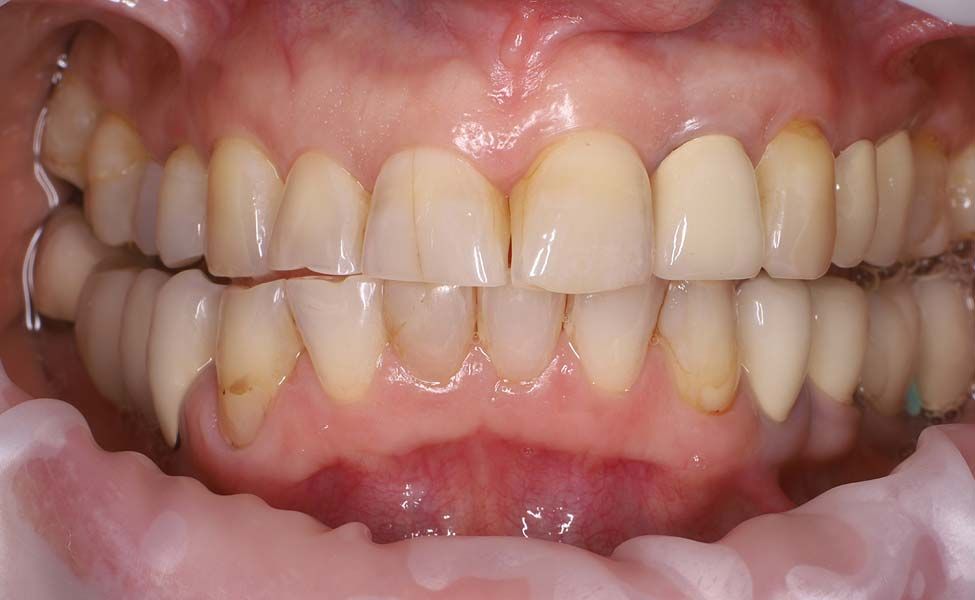 Протезирование зубов до лечения