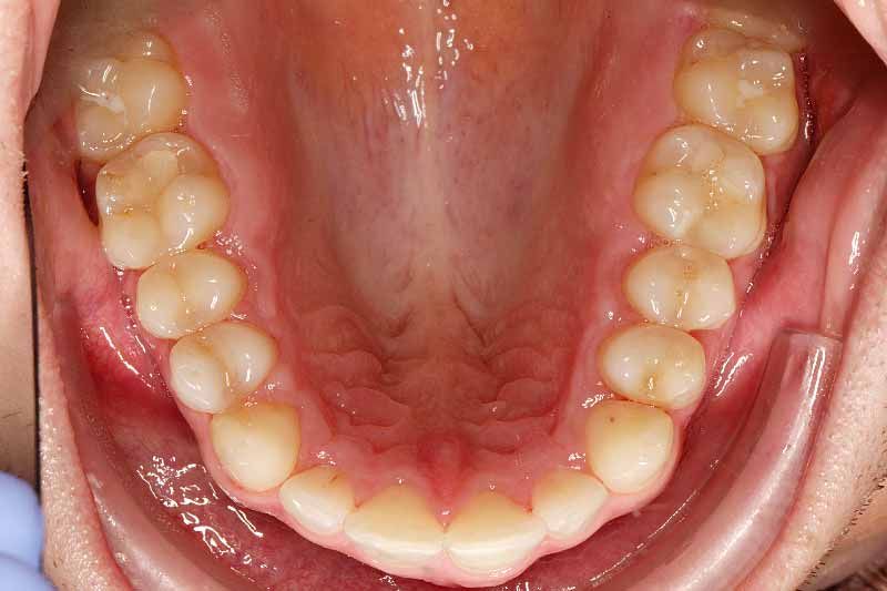 результат после лечения элайнерами