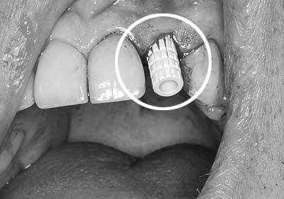 Имплантация передних зубов