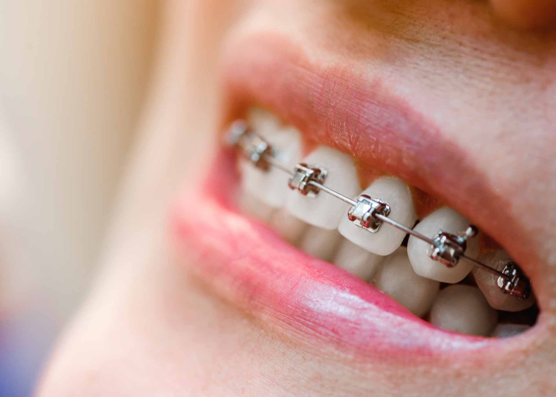 Безлигатурные брекеты