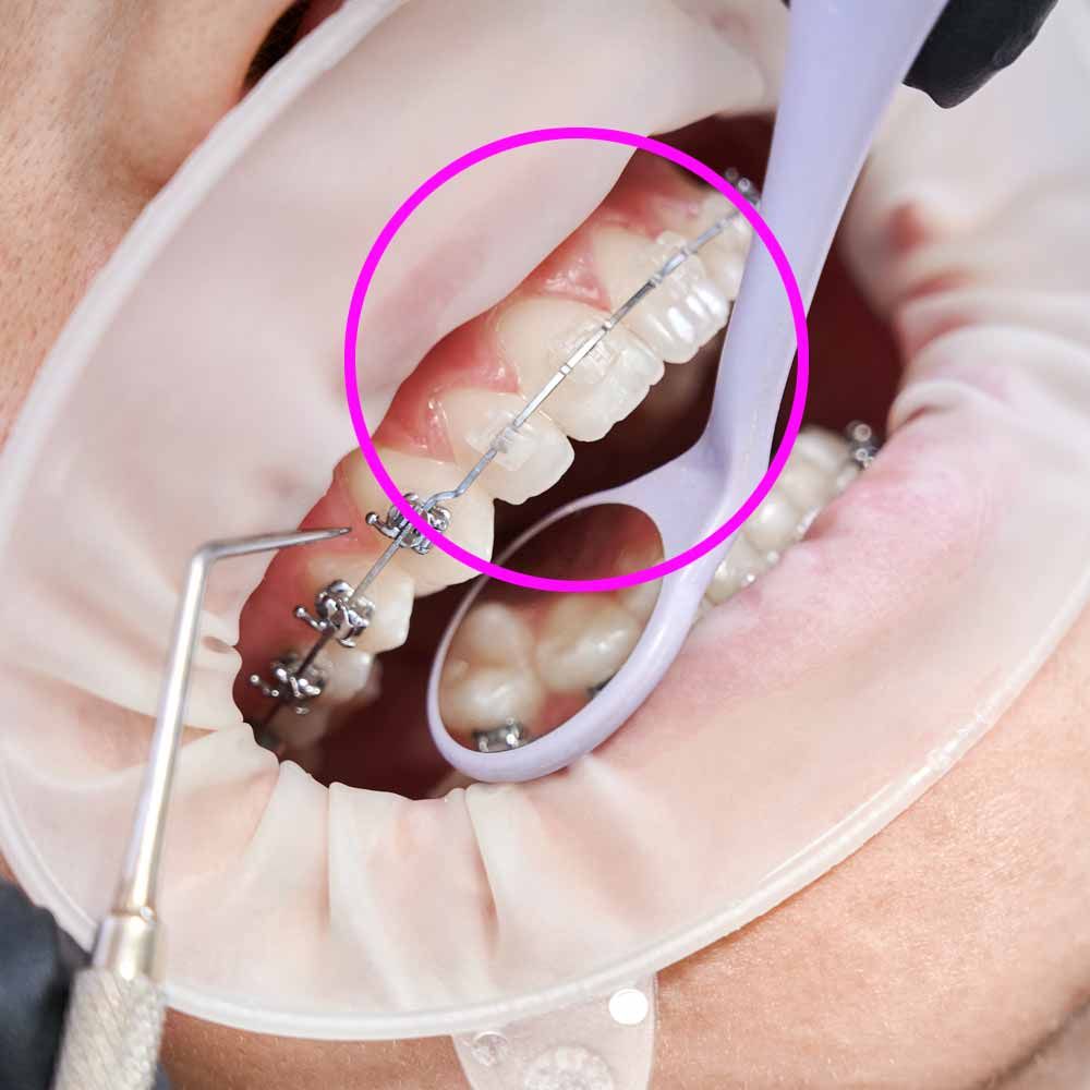 Безлигатурные брекеты как Damon Clear