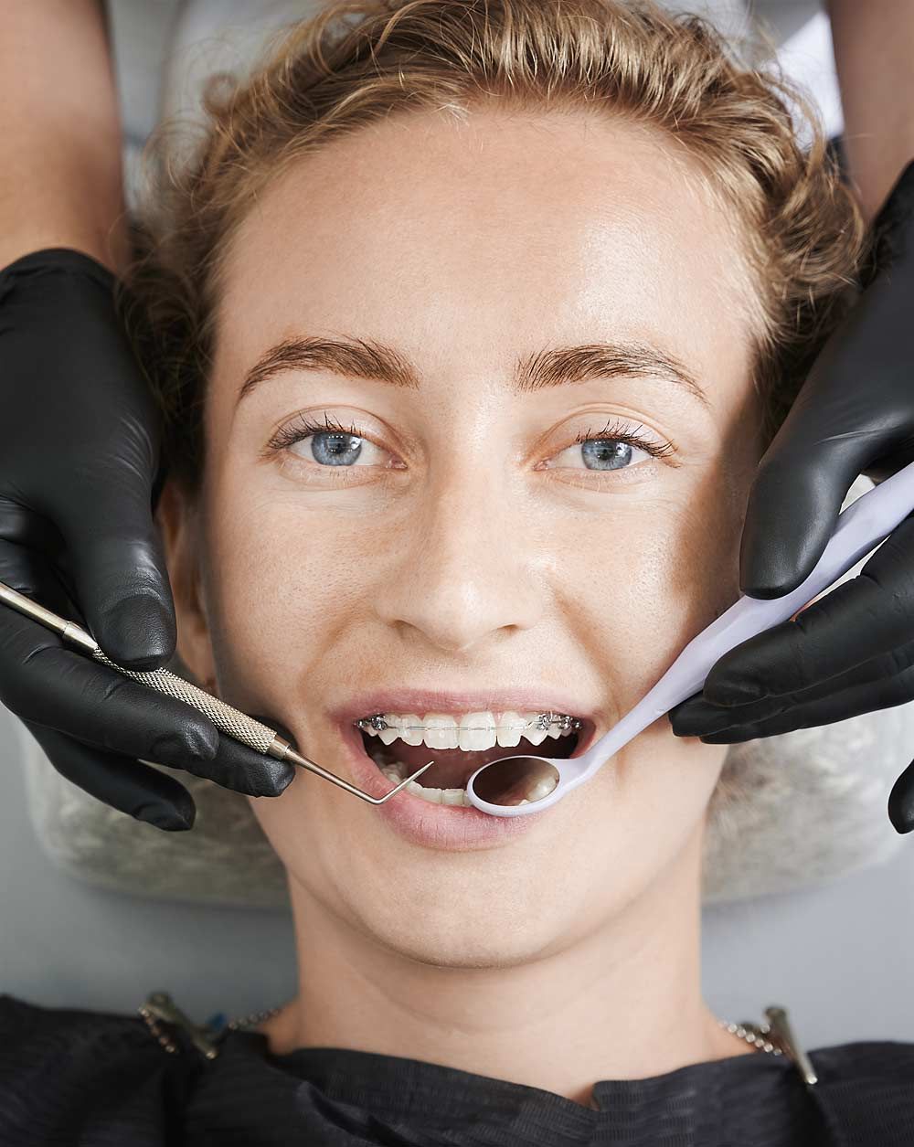 металлические брекеты