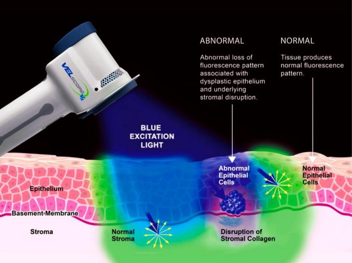 Распознавание при помощи Velscope раковых образований слизистой ротовой полости